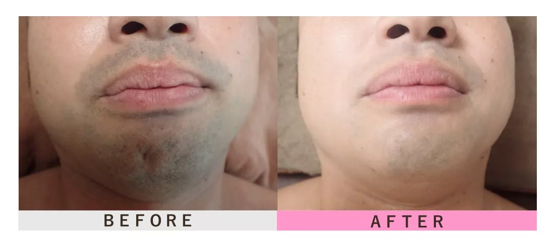 ひげ脱毛のビフォーアフター