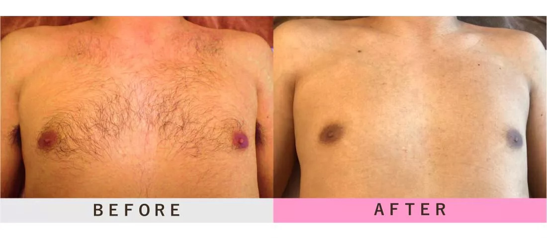 胸・背中上・お腹・へそ下ギャランドゥの脱毛のビフォーアフター