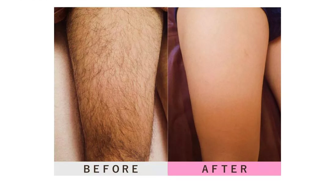 膝上・膝下の脱毛のビフォーアフター
