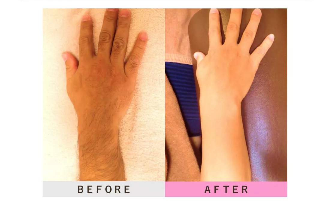 肘下・手甲指の脱毛のビフォーアフター